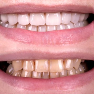 Vorher-Nachher-Vergleich von Zähnen nach ästhetischer Zahnkorrektur mit Veeners