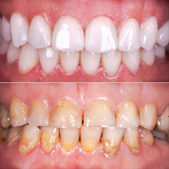 Vorher-Nachher-Vergleich ästhetische Zahnkorrektur