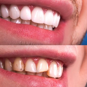 Vorher-Nachher-Vergleich ästhetische Zahnkorrektur mit Keramik