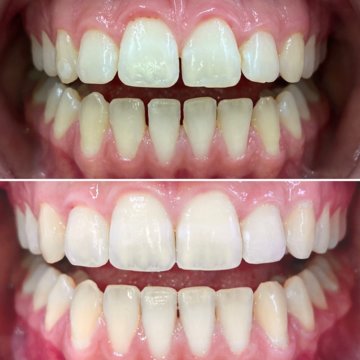 Vorher-Nachher-Vergleich ästhetische Zahnkorrektur mit Invisalign