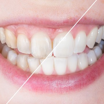 Vorher-Nachher-Vergleich von Zähnen nach Bleaching