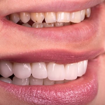 Vorher-Nachher-Vergleich ästhetische Zahnkorrektur mit Veeners