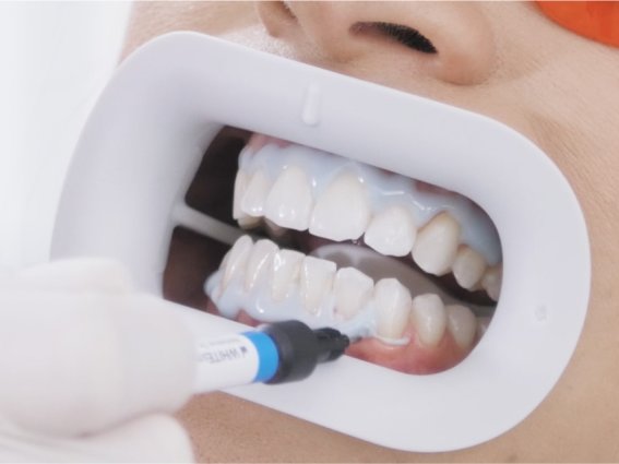 Anwendnung von Bleaching-Textur auf den Zähnen eines Patienten