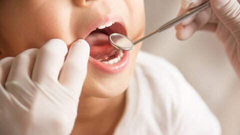 Zähne eines Kindes werden mit Instrumenten behandelt